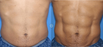 Man treated with truSculpt flex - Man treated with truSculpt flex