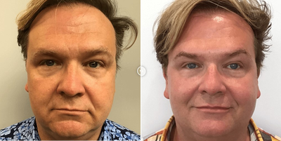 Man treated with Aquagold - Man treated with Aquagold