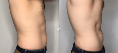 Man treated with truSculpt flex - Man treated with truSculpt flex