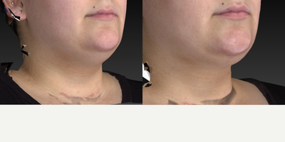 25-34 year old woman treated with Chin Liposuction - Chin and neck liposuction procedure to create a nice sculpted look around the area.