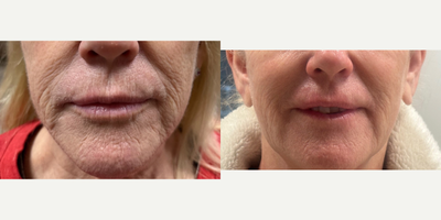 55-64 year old woman treated with Dermal Fillers, PRP Injections, Skin Rejuvenation - This client was treated with Dr. Song's signature Autocorre HD treatment. This combines your own body's regenerative powers with dermal fillers to stimulate collagen production, create a suddle lift, and smooth out fine lines & wrinkles.