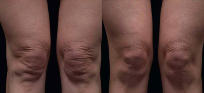 Thermage body - 
	Thermage was performed on the knees to help tighten the skin.

