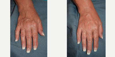 55-64 year old woman treated with Radiesse 1.5cc into each hand. - This 62 year-old female presents desiring treatment for prominent veins on the dorsal surface of her hand. Using topical anesthesia, 1.5 cc of Radiesse was strategically injected and then massaged, resulting in a smoother and rejuvenated surface of the hand.