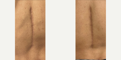Man treated with Renuva - Man treated with adsFZ