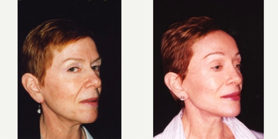 65-74 year old woman treated with Facelift Revision, Lip Surgery, Brow Lift - Facelift revision (previous facelift 2 years prior), brow lift, upper lip lift with fat transfer, lower FATMA, lower blepharoplasty, CO2