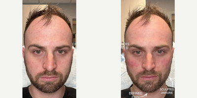 Man treated with Facial - Man treated with Facial