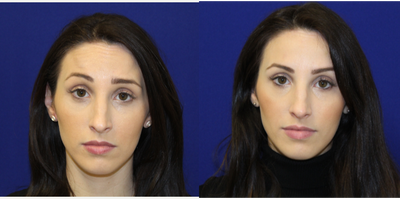 25-34 year old woman treated with Xeomin - 29 year old female feeling like she always looks tired. She wanted to do something quick that would make her appear rested and not look so worried or angry. She underwent xeomin injections to her forehead, glabella (11 lines) and crows feet. Here she is after a few weeks looking refreshed.