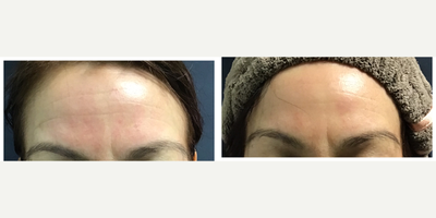 35-44 year old woman treated with Pelleve - Before and after 4 Pelleve treatments to forehead.