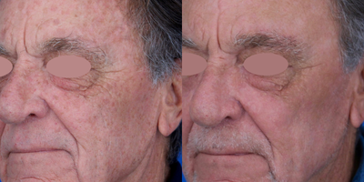 75 and up year old man treated with Chemical Peel, Laser Scar Removal, Scar Removal, Skin Rejuvenation, Laser Resurfacing, Skin  - We implemented a comprehensive combination therapy approach for a patient with an array of concerns, including multiple actinic keratosis, seborrheic keratosis, lentigines, age spots, hyperpigmentation, and skin laxity. Photos show the stunning transformation in just 3 months' time.