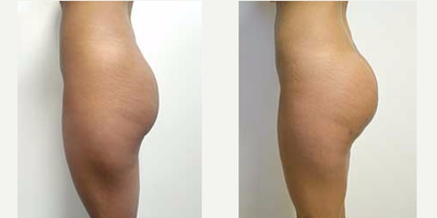 25-34 year old woman treated with Butt Augmentation - 25-34 year old woman treated with Butt Augmentation