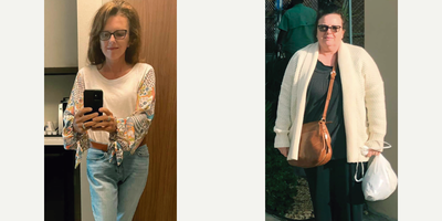 Woman treated with Gastric Bypass - Woman treated withGastric Bypass