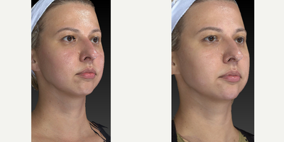 25-34 year old woman treated with Injectable Fillers - This young pretty girl came in for some chin and jawline sculpting. Dr. Caughlin is becoming known for these procedures. Pay attention to the angle of the jaw and chin projection.