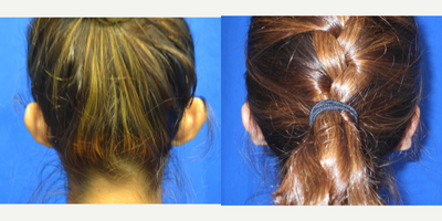 25-34 year old woman treated with Ear Surgery - 27 year old female who is 6 weeks after ear pinning (otoplasty) surgery. She complained that her ears stuck out too much and she wanted them set back. She is very happy and now wears her hair up, something she never did before. The incisions are hidden in the natural grooves behind her ears. Her height is 5 feet 6 inches and her weight is 112 lbs. She has one child.