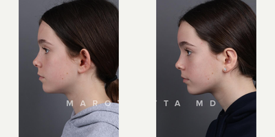Woman treated with Ear Surgery - One of our awesome patients six months post-otoplasty!What is Otoplasty?Otoplasty is a surgical procedure designed to reshape and reposition the ears. For many, its a transformative journey towards increased self-esteem and confidence.The Journey: Before & AfterWitness the remarkable transformation of a young girl who embraced otoplasty with Dr. Marotta. Swipe left to see the incredible before-and-after images.Why Choose Marotta MD?Dr. Marottas precision and artistry in otoplasty reflect his commitment to enhancing natural beauty. With a wealth of experience, his approach combines technical expertise with a deep understanding of each patients unique needs.Your path to confidence starts here. Ready to explore the possibilities? Take the first step towards newfound confidence. Schedule a consultation with Marotta MD today.