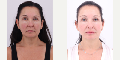 55-64 year old woman treated with Facelift, Neck Lift, Buccal Fat Removal - 60 year old patient 6 months after Facelift, Neck lift and Buccal Fat Removal