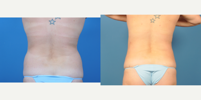 25-34 year old woman treated with Liposuction - Liposuction of flanks and bra-line area