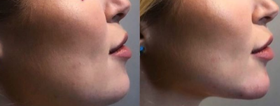 25-34 year old woman treated with Teosyal - 25-34 year old woman treated with Teosyal