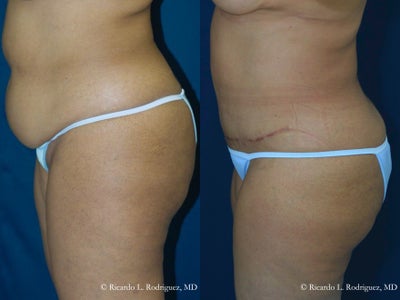 Abdominoplasty - 
	patient desired a firmer abdomen, smaller waist and smaller lifted breasts. This 50 year old female had a full abdominplasty, liposuction to her flanks and breast reduction surgery with iv-sedation anesthesia (twilight).Dr. Rodriguez uses the vertical scar technique, which eliminates the horizontal scars under the breast used in other techniques. The vertical incision also gives a more youthful and perky shape to the breast. The patient was able to go back to work 4 weeks after her procedure.&nbsp;