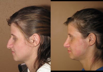 Nose job/ rhinoplasty - 
	Nose job/ rhinoplasty
