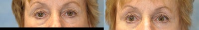 57 Year Old Female Treated for Unacceptable Cosmetic Appearance of Eyes - 
	57 Year Old Female Diagnosis: Unacceptable Cosmetic Appearance of Eyes Procedure: Bilateral Upper Blepharoplasty
