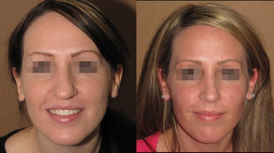 Rhinoplasty/nose job - 
	Open rhinoplasty correction of the bulbous tip
