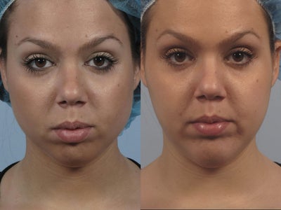 Chin implant for short lower third of face - Custom silicone chin implant for small chin performed
