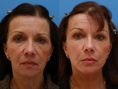 58 Year Old Lady After Revision Facelift - This patient wished overall improvement of her facial appearance. She had mini-facelift surgery a few years earlier and wished to avoid the stretched look. Important was the addition of fat transfer and skin rejuvenation (facial peel and dermabrasion around the mouth). All procedures were performed in in one setting.