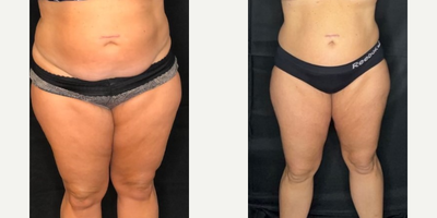 Woman treated with Evolve - Woman treated with Evolve
