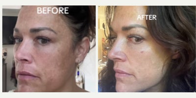 Woman treated with VI Peel - Woman treated with VI Peel, Clear & Brilliant Laser, and use of Alastin Products to improve tone, texture, and brightness.