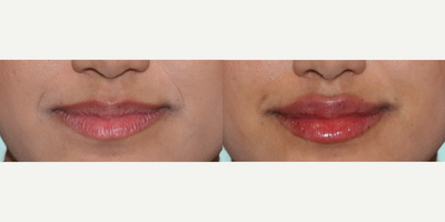 Woman treated with RHA Collection Fillers - Our patient received just 1/2 syringe of RHA 3, to achieve these stunning lips.Subtle Enhancement: A little goes a long way! With just 1/2 syringe, weve added volume and definition for a natural, beautiful pout.RHA 3 Magic: This advanced filler provides a smooth, flexible finish that moves naturally with your expressions.