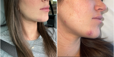 Woman treated with Cyst Removal - Cyst REmoval