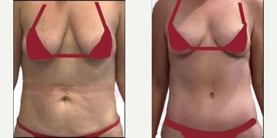 Woman treated with Tummy Tuck - Woman treated with Tummy Tuck.