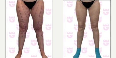 Woman treated with Liposuction - Woman treated with Liposuction.