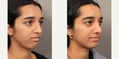 18-24 year old woman treated with Rhinoplasty with an Alarplasty (Nostril Reduction) - Dr. Lexie Wang performed a Rhinoplasty with an Alarplasty (Nostril Reduction). The patient is 4 months post-op.