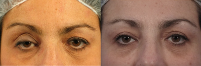 Blepharoptosis repair with injectable HA filler to brows - This patient had a right upper eyelid ptosis (blepharoptosis) related to years of hard contact lens use. It led to the sulcus deformity on the right side (a hollow space above the eyelid). Ptosis repair was performed through an eyelid crease incision by repairing a separated muscle tendon (aponeurosis repair).  Filler was also injected (Perlane) beneath the brows to restore volume and simulate a brow lift.