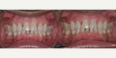 35-44 year old man treated with Gum Lift - Patient shown was treated for gum recession in our office through the innovative Pinhole Surgical Technique.