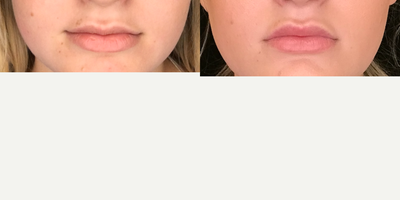 18-24 year old woman treated with Volbella - 18-24 year old woman treated with Volbella on the upper lip in order to make the upper and lower lip even in terms of volume.