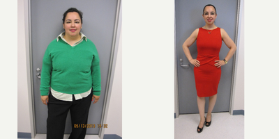 35-44 year old woman treated with Sleeve Gastrectomy - Our patient began her journey weighing 253.8 lbs with a BMI of 42.1. After 1 year and 8 months of complete dedication and determination, our patient is weighing 142 lbs and has a BMI of 23.6.