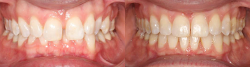 35-44 year old woman treated with Clear Braces - Treatment: 22 months of comprehensive orthodontics with clear braces for the treatment of a deep overbite.