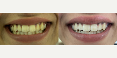 35-44 year old woman treated with Zoom Whitening - Brighter Smile with zoom whitening within an hour