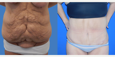 35-44 year old woman treated with Panniculectomy - This patient lost extreme weight and had excess skin for removal.