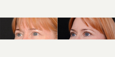 Woman treated with Brow Lift - Woman treated with Brow Lift.