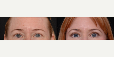Woman treated with Brow Lift - Woman treated with Brow Lift.