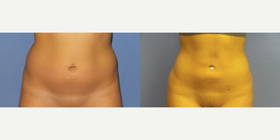 23 year old woman treated with Brazilian Butt Lift - 23 y/o female 6 weeks s/p BBL with lipo of abdomen and flanks and 600 cc of fat placed to each buttock.