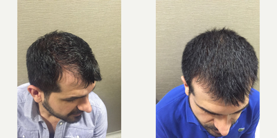 25-34 year old man treated with PRP for Hair Loss - Results of 5 session of PRP treatment or 13 months with 1000mg Biotin per day.