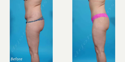 Woman treated with Liposuction Revision  - Woman treated with Liposuction Revisionto flanks as well as Tummy Tuck Revisionwithlowered incision below panty line and Belly ButtonRevision.