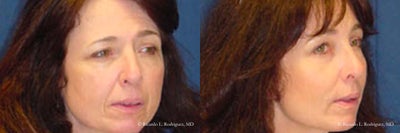 Woman in her 50s treated with Brow Lift. - Woman in her 50s with moderate ptosis (drooping) of the upper eyes treated with Brow Lift.