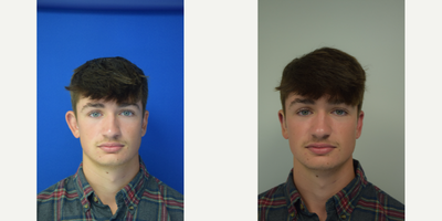 18-24 year old man treated with Ear Surgery, Earfold - Patient with unilateral ear deformity, wanted both ears to look the same. What a great difference and he feels much more confident now!