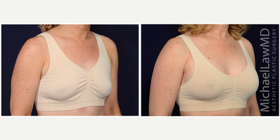 45-54 year old woman treated with Natrelle Breast Implants - Breast augmentation. Follow-up photos are taken 8 months after the procedure.