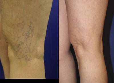 spider vein treatments - patient had bad spider veins on leg. sclerotherapy using 0.5% asclera, fda approved, medicine to treat it.